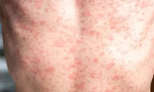 पूरे अमेरिका में खसरे के मामले बढ़ने के साथ ही  फैल रही है गलत सूचना