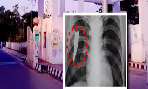 एमकेसीजी के डॉक्टरों ने 3 साल बाद 24 वर्षीय युवक के फेफड़े से 8 सेंटीमीटर चाकू का टुकड़ा निकाला एमकेसीजी के डॉक्टरों ने 3 साल बाद 24 वर्षीय युवक के फेफड़े से 8 सेंटीमीटर चाकू का टुकड़ा निकाला