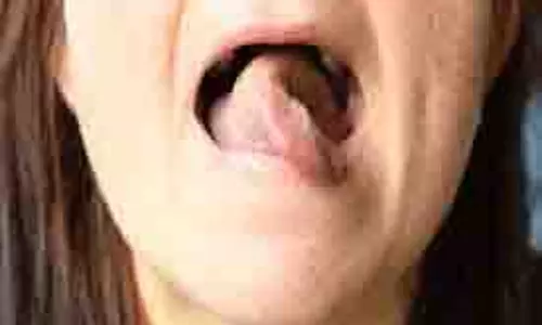 Health :जानिए क्यों होती है जुबान में हकलाहट, इसका कारण और उपचार Health :जानिए क्यों होती है जुबान में हकलाहट, इसका कारण और उपचार