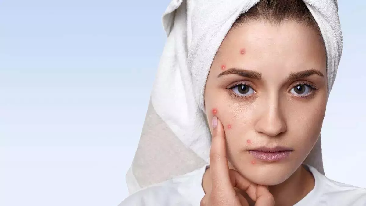 Acne in adults: हार्मोन या लाइफस्टाइल Acne in adults: हार्मोन या लाइफस्टाइल