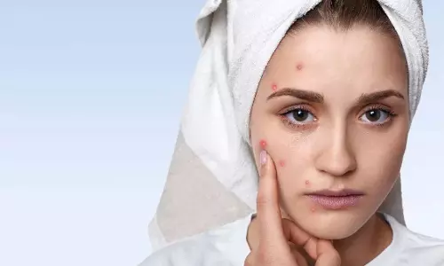 Acne in adults: हार्मोन या लाइफस्टाइल Acne in adults: हार्मोन या लाइफस्टाइल