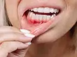 Health: मुंह में बार-बार छाले होना किस बीमारी का लक्षण है Health: मुंह में बार-बार छाले होना किस बीमारी का लक्षण है