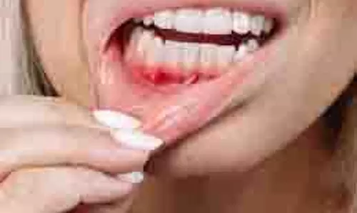 Health: मुंह में बार-बार छाले होना किस बीमारी का लक्षण है Health: मुंह में बार-बार छाले होना किस बीमारी का लक्षण है