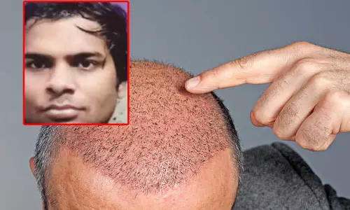 हेयर ट्रांसप्लांट,  एक और इंजीनियर की मौत से मची खलबली