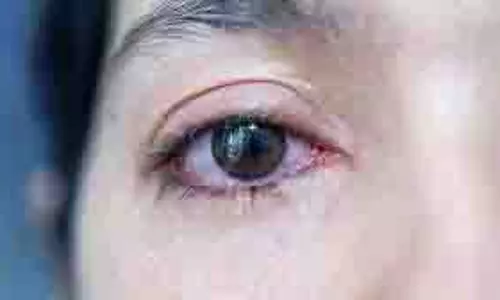 Eye Irritation:  आप गर्मियों में आंखों में जलन और सूजन से परेशान हैं, इन आसान घरेलू उपायों को आजमाएं