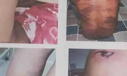 पार्षद ने गुर्गो के साथ दिया लाल जख्म, हमले में युवक के कान का पर्दा फटा पार्षद ने गुर्गो के साथ दिया लाल जख्म, हमले में युवक के कान का पर्दा फटा