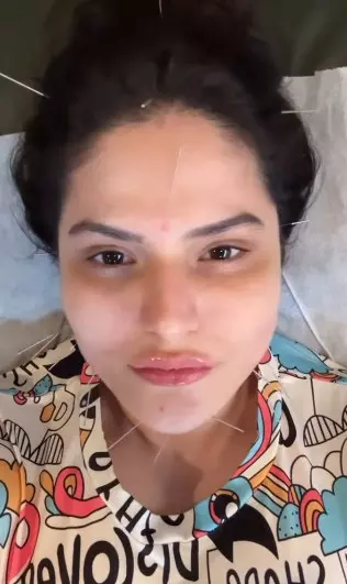 फेशियल एक्यूपंक्चर: चेहरे की चमक बढ़ाने के साथ कई समस्याओं का समाधान है छोटी सी ‘सुई’ फेशियल एक्यूपंक्चर: चेहरे की चमक बढ़ाने के साथ कई समस्याओं का समाधान है छोटी सी ‘सुई’