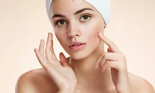 Beauty Tips:  चेहरे से मुंहासे हटाने के घरेलू उपाय