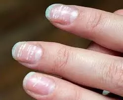 Health : नाखूनों पर सफेद धब्बे का दिखना किस बीमारी का लक्षण है Health : नाखूनों पर सफेद धब्बे का दिखना किस बीमारी का लक्षण है