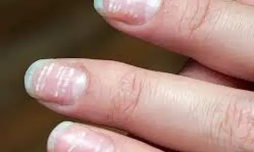 Health : नाखूनों पर सफेद धब्बे का दिखना किस बीमारी का लक्षण है Health : नाखूनों पर सफेद धब्बे का दिखना किस बीमारी का लक्षण है