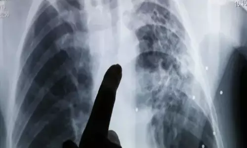 टीबी मरीजों के लिए राहत की खबर, 1 लाख 20 हजार की सहायता राशि जारी