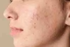 Skin Care: माथे पर पिंपल्स होने का क्या कारण है, इनसे कैसे छुटकारा पाएं Skin Care: माथे पर पिंपल्स होने का क्या कारण है, इनसे कैसे छुटकारा पाएं