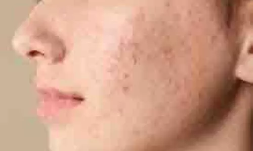 Skin Care: माथे पर पिंपल्स होने का क्या कारण है, इनसे कैसे छुटकारा पाएं Skin Care: माथे पर पिंपल्स होने का क्या कारण है, इनसे कैसे छुटकारा पाएं