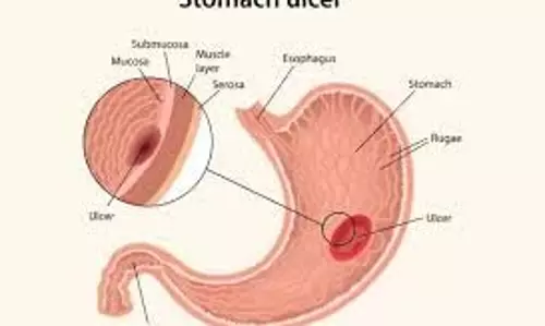 Health: जानिए पेट के अल्सर के क्या हैं, लक्षण