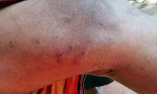 पम्ब्रा एस्टेट में पार्थेनियम का रोपण; श्रमिकों में बीमारी फैली