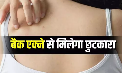 पीठ पर निकलने वाले Acne कर रहे हैं परेशान, राहत के लिए अपनाएं 4 टिप्स पीठ पर निकलने वाले Acne कर रहे हैं परेशान, राहत के लिए अपनाएं 4 टिप्स