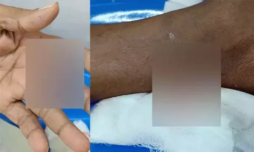 Kerala : आवारा कुत्ते ने दो लोगों को काटा, छाते से कुत्ते को भगाया