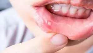 Health: क्या पेट की गर्मी से मुंह में छाले होते हैं? जानिए घरेलू उपचार Health: क्या पेट की गर्मी से मुंह में छाले होते हैं? जानिए घरेलू उपचार