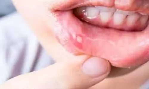 Health: क्या पेट की गर्मी से मुंह में छाले होते हैं? जानिए घरेलू उपचार Health: क्या पेट की गर्मी से मुंह में छाले होते हैं? जानिए घरेलू उपचार
