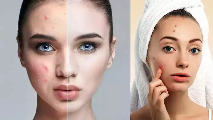 पिंपल पैच vs फेसवॉश : क्या वाकई करता है काम? जानिए डॉक्टर की राय पिंपल पैच vs फेसवॉश : क्या वाकई करता है काम? जानिए डॉक्टर की राय