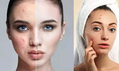 पिंपल पैच vs फेसवॉश : क्या वाकई करता है काम? जानिए डॉक्टर की राय पिंपल पैच vs फेसवॉश : क्या वाकई करता है काम? जानिए डॉक्टर की राय