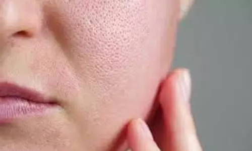 Skin Care: चेहरे पर खुले रोमछिद्रों से हैं परेशान तो आजमाएं ये घरेलू उपाय, जल्द दिखेगा असर