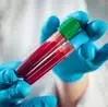 नए रक्त परीक्षण से अब जानलेवा ब्लड कैंसर का जल्दी पता लगेगा : अध्ययन नए रक्त परीक्षण से अब जानलेवा ब्लड कैंसर का जल्दी पता लगेगा : अध्ययन