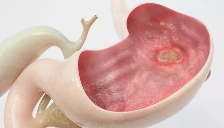 5 बड़े संकेत जो बताते हैं कि आपको पेट में अल्सर है 5 बड़े संकेत जो बताते हैं कि आपको पेट में अल्सर है