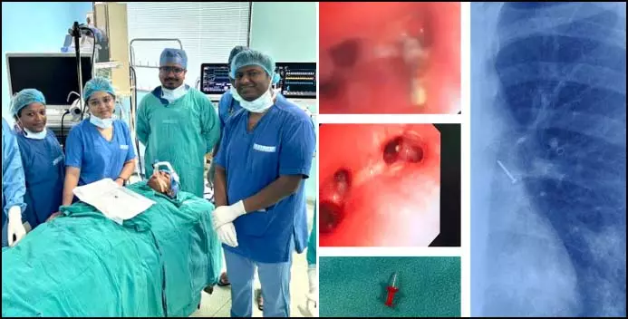 फेफड़े में फंसी थी पिन, किशोर की जान रायपुर एम्स के डॉक्टरों ने बचाई फेफड़े में फंसी थी पिन, किशोर की जान रायपुर एम्स के डॉक्टरों ने बचाई