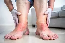 Health: लिवर खराब होने पर पैरों में दिखने लगते हैं ये गंभीर लक्षण, ऐसे करें पहचान Health: लिवर खराब होने पर पैरों में दिखने लगते हैं ये गंभीर लक्षण, ऐसे करें पहचान