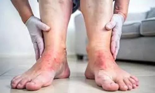 Health: लिवर खराब होने पर पैरों में दिखने लगते हैं ये गंभीर लक्षण, ऐसे करें पहचान