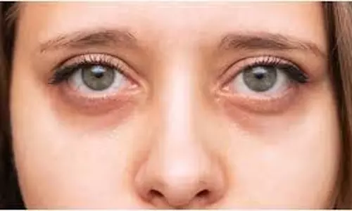 Beauty tips:डार्क सर्कल्स के पीछे क्या है असली वजह, कैसे पाएं इनसे छुटकारा