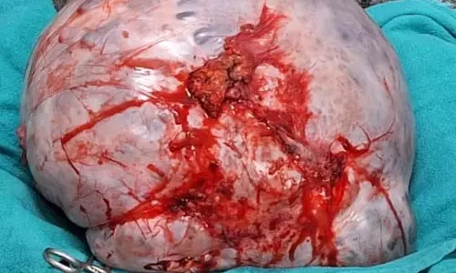 पेट में सूजन की शिकायत लेकर हॉस्पिटल पहुंची महिला, 10 किलो का ट्यूमर डॉक्टरों ने निकाला
