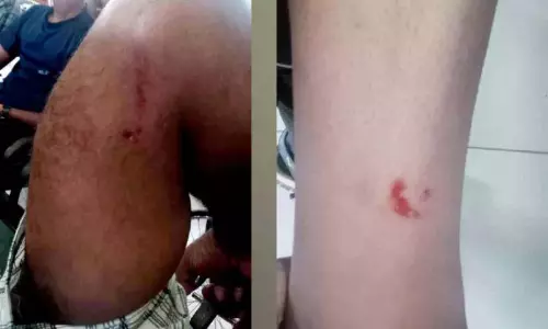 Kerala : कुत्ते के काटने से बच्चों समेत सात लोग घायल Kerala : कुत्ते के काटने से बच्चों समेत सात लोग घायल