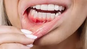 Health: क्या बार-बार मुँह के छाले होना पेट की समस्या है या कुछ और Health: क्या बार-बार मुँह के छाले होना पेट की समस्या है या कुछ और