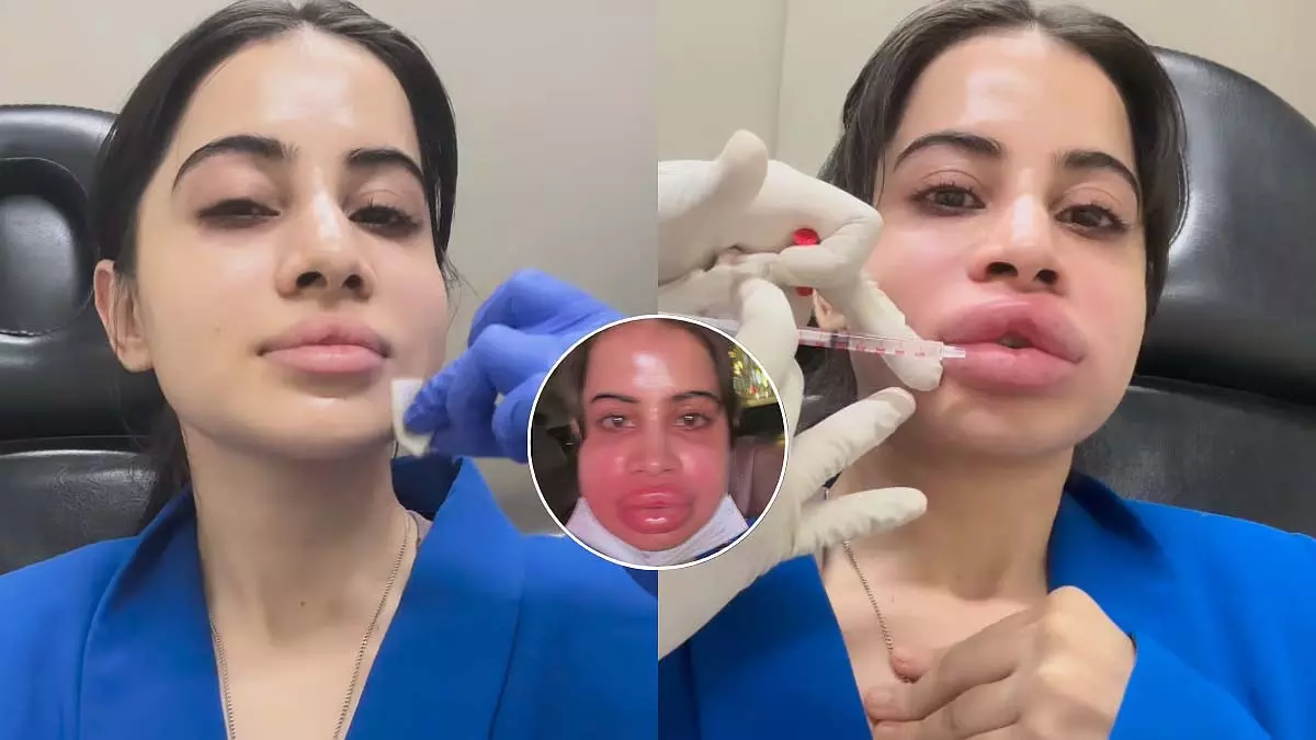 Urfi Javed : चौंकाने वाला खुलासा, लिप फिलर्स से तौबा का किया ऐलान Urfi Javed : चौंकाने वाला खुलासा, लिप फिलर्स से तौबा का किया ऐलान