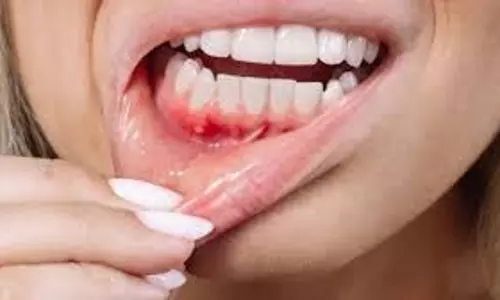 Health: क्या बार-बार मुँह के छाले होना पेट की समस्या है या कुछ और Health: क्या बार-बार मुँह के छाले होना पेट की समस्या है या कुछ और