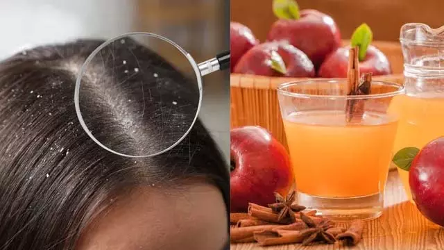 इस मानसून में प्राकृतिक रूप से रूसी हटाने के 5 बेहतरीन DIY उपचार इस मानसून में प्राकृतिक रूप से रूसी हटाने के 5 बेहतरीन DIY उपचार