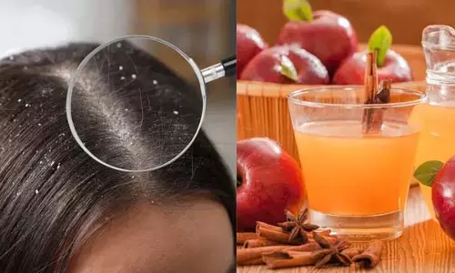 इस मानसून में प्राकृतिक रूप से रूसी हटाने के 5 बेहतरीन DIY उपचार इस मानसून में प्राकृतिक रूप से रूसी हटाने के 5 बेहतरीन DIY उपचार