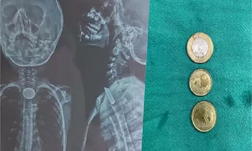 Sonipat: खेलते-खेलते बच्चे की जान खतरे में, निगल गया 5-10 रुपये के सिक्के, डॉक्टरों ने ऐसे बचाई जान Sonipat: खेलते-खेलते बच्चे की जान खतरे में, निगल गया 5-10 रुपये के सिक्के, डॉक्टरों ने ऐसे बचाई जान