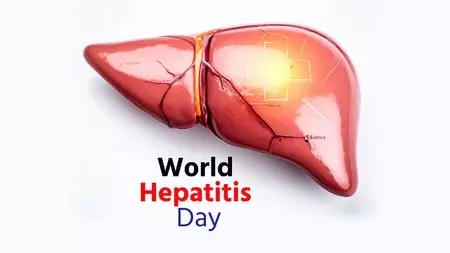 विश्व हेपेटाइटिस दिवस : साइलेंट किलर से सावधान, जागरूकता है उपाय विश्व हेपेटाइटिस दिवस : साइलेंट किलर से सावधान, जागरूकता है उपाय