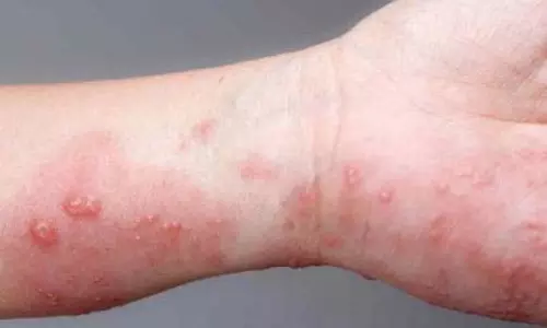 Blistering Disease की शुरुआत सामान्य होती है, लेकिन इसके परिणाम गंभीर होते हैं