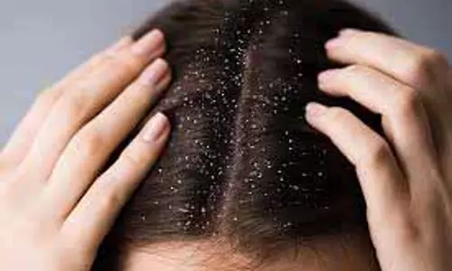 Health: मानसून में क्यों बढ़ जाती है रूसी की समस्या, कैसे करें बचाव Health: मानसून में क्यों बढ़ जाती है रूसी की समस्या, कैसे करें बचाव