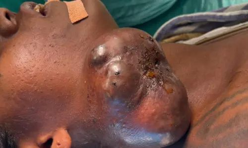 गले के कैंसर से बैगा महिला को मिली राहत, सिम्स के डॉक्टरों का कमाल
