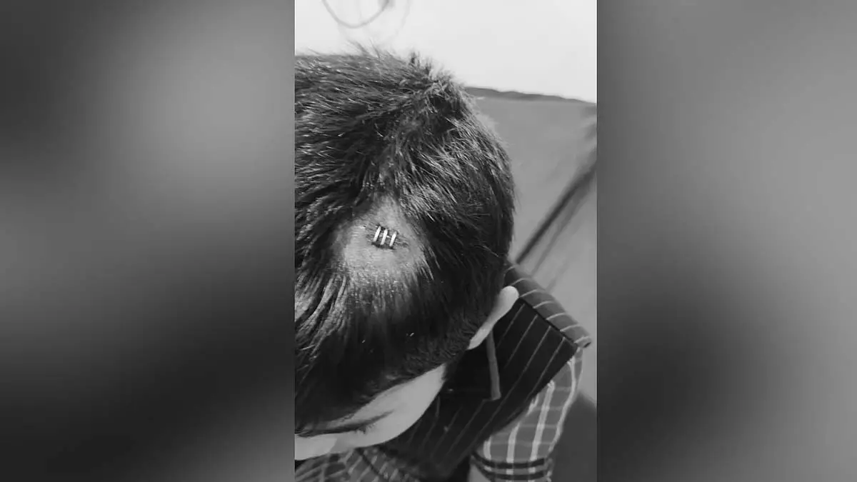 तेलंगाना में शिक्षक की लापरवाही से बच्चे को सिर में लगी चोट तेलंगाना में शिक्षक की लापरवाही से बच्चे को सिर में लगी चोट