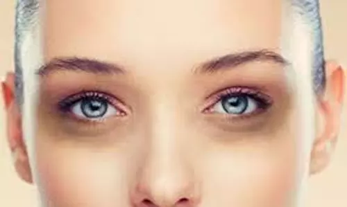Beauty Tips:आंखों के नीचे काले घेरे हटाने के घरेलू उपाय