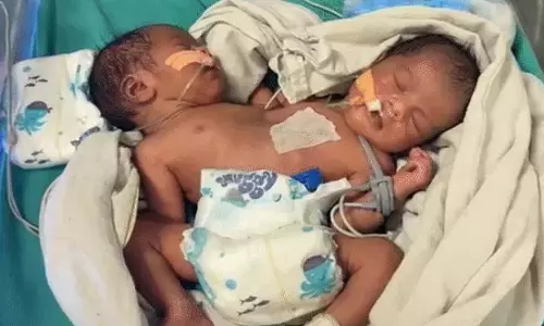 Indore : फिर सामने आया जुड़वाँ बच्चों का दुर्लभ मामला