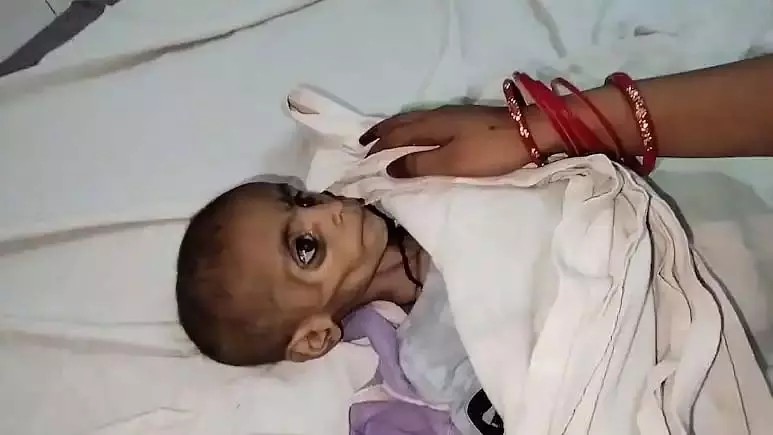 Shivpuri: 15 महीने की बच्ची की कुपोषण से मौत Shivpuri: 15 महीने की बच्ची की कुपोषण से मौत