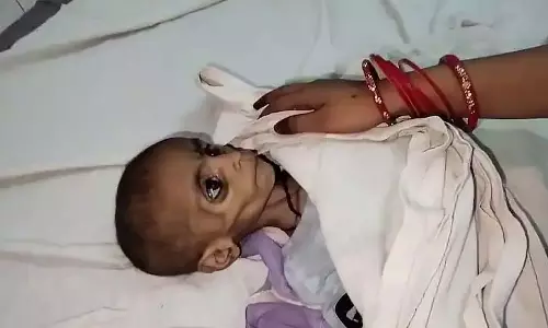 Shivpuri: 15 महीने की बच्ची की कुपोषण से मौत