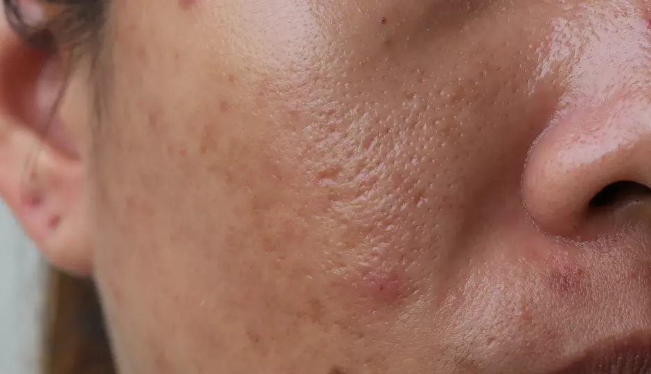 गर्मियों में Oily skin को कहें अलविदा – ट्राय करें ये 6 ब्यूटी हैक्स